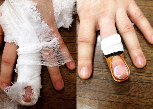 Травма разгибателя пальца  (mallet finger)