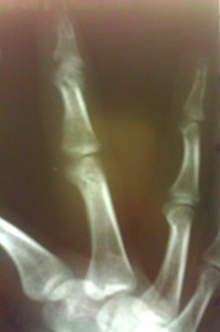 рентген сломанного пальца
