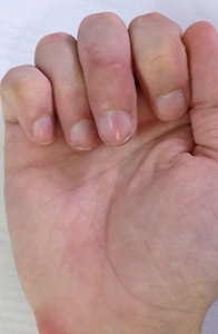 палец после операции