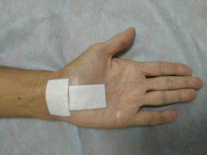 Рука после операции на запястном канале