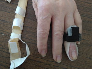 Травма разгибателя пальца  (mallet finger)