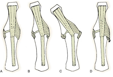  Анатомия локтевой коллатеральной связки первого пястно-запястного сустава.
