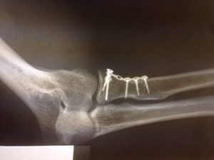 Рентгеновские снимки локтевого сустава после операции по остеосинтезу головки лучевой кости. Прямая проекция.