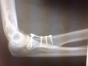 Рентгеновские снимки локтевого сустава после операции по остеосинтезу головки лучевой кости. Боковая проекция.
