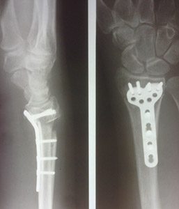Рентгеновский снимок перелома лучевой кости после операции.