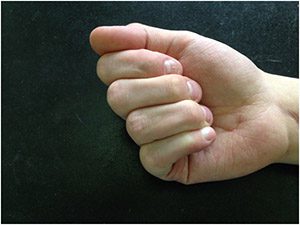 Пластика сгибателя пальца (возвращение подвижности)