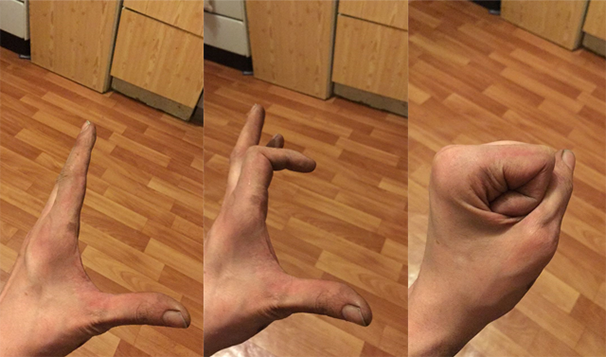 Неправильно сросшийся перелом пальца руки