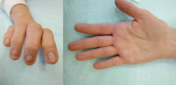 nepravilno srosshijsya perelom palca ruki 8