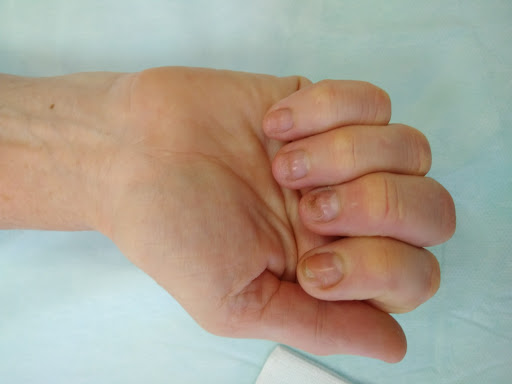 nepravilno srosshijsya perelom palca ruki 9